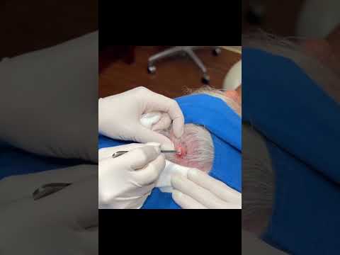 Surprise Scalp Cyst