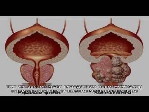 Симптомы аденомы простаты у мужчин и лечение заболевания