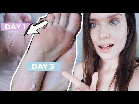 Baby Foot Exfoliation Foot Peel | Before and After Baby Feet Peel Off Mask- How To