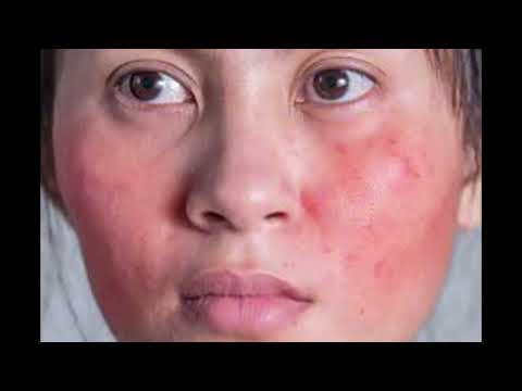 Beauty Tips Series Vol 2 -9 Possible side effects of oral Isotretinoin in managing Acne