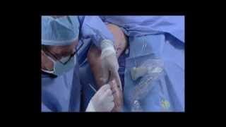 Endovenous Laser Ablation and Ambulatory Phlebectomy (Training Video)