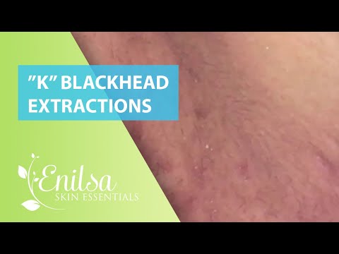 Blackheads Extractions “K’s” 5th Treatment