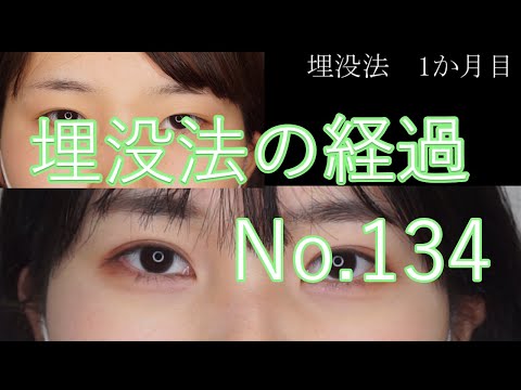 埋没法　134　目頭の形に左右差のある方