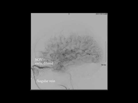 Trans-superior ophthalmic vein approach for treatment of carotid-cavernous fistula