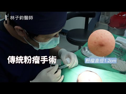 傳統粉瘤手術-極緻美型·文心極緻美型皮膚科診所整形手術-林子鈞醫師：台中粉瘤_粉瘤手術_微創粉瘤_粉瘤健保