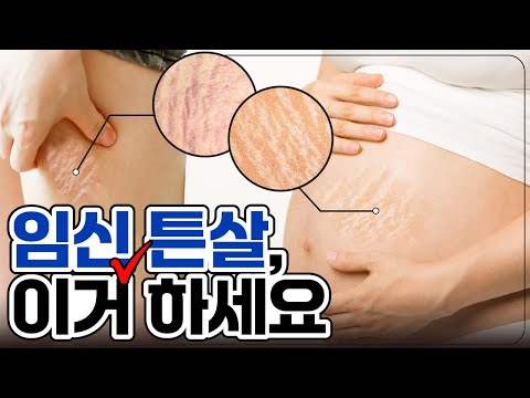 피부과 전문의가 알려주는 튼살의 모든 것｜임신 튼살 원인, 치료 방법, 피부과 시술