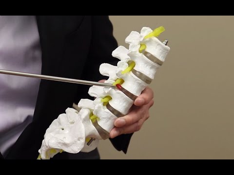 Innovative Help For A Herniated Disc