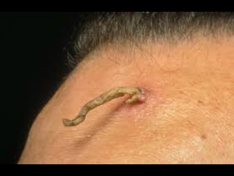 blackheads new this week | pimple popping