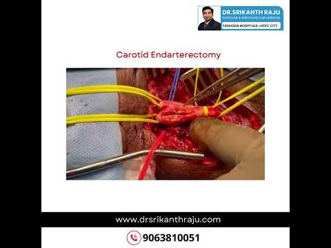 Carotid Endarterectomy Case Study | Dr.Srikanth Raju | Vascular Surgeon | Hyderabad