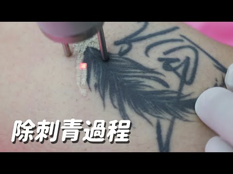 除刺青過程-極緻美型·文心極緻皮膚科診所整形手術-林子鈞醫師：台中雷射除剌青_雷射除剌青_除剌青