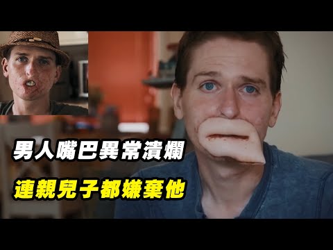 男人嘴巴異常潰爛，四肢被同時切除，連親兒子都嫌棄他！紀錄片