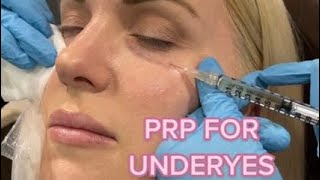 Undereye PRP Injections