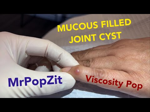 Gel filled viscous joint pop.Joint cyst contents expressed and pocket is heat cauterized to close it