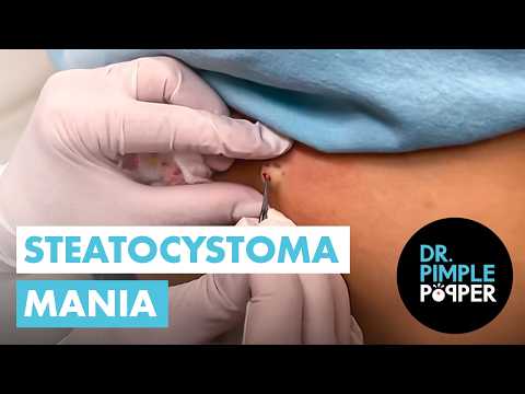 Steatocystoma Mania