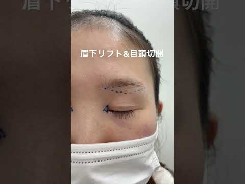 20代女性。眉下リフト&目頭切開でアーモンドアイに。