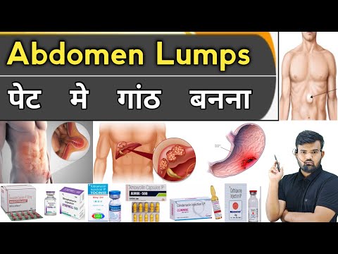 Abdomen Lumps | पेट में गांठ बनना | Medicine | Treatment | Pharmacy | Hospital | Doctor | Nursing