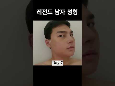 남자 전체성형 과정 #shorts