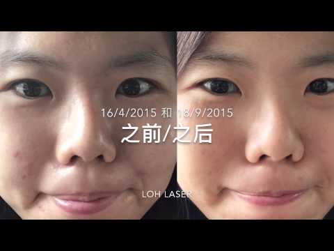 Loh Laser Cosmetic & Surgery：SilkPeel™ Dermallnfusion