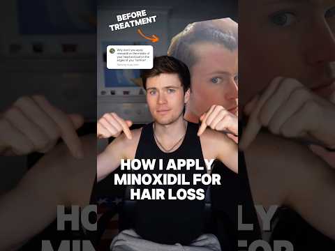 How I use minoxidil for my hair loss!