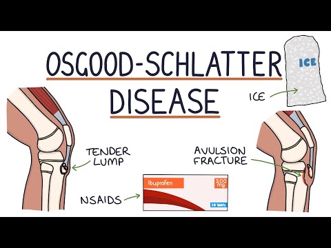 Understanding Osgood-Schlatter Disease