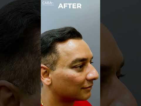 Cara's Hair Transplant Transformation! Before and After Results