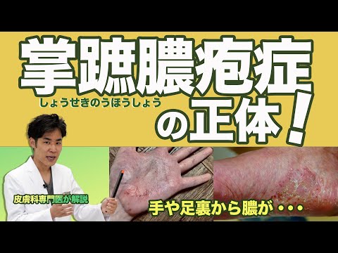 掌蹠膿疱症の正体！手の平や足の裏から膿が・・・