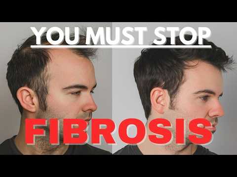 Scalp Fibrosis - Is THIS the Real Reason for Hair Loss in Men?