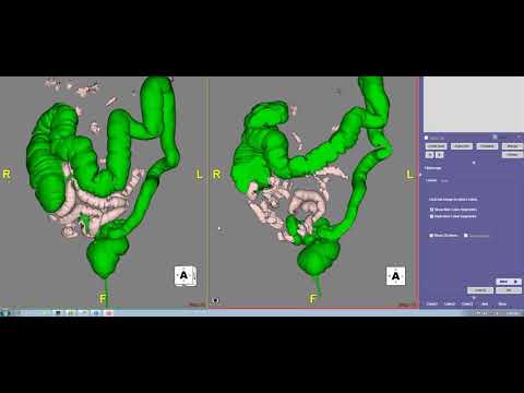 CT Colonography