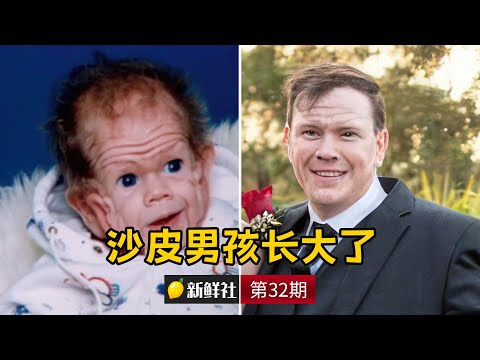 男孩皮肤如同沙皮狗 如今长大变帅哥 新鲜社 | 32期