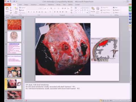 Medical School Pathology, 2013 Season, Session #6: Hemodynamic Disorders I