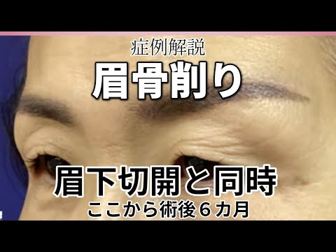 眉骨削りと眉下切開。整形手術後6か月の症例　名古屋こいずみ形成クリニック