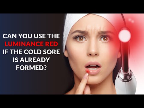 Can You Use the Luminance RED if the Cold Sore is Already Formed? (Cold Sore Laser Treatment)