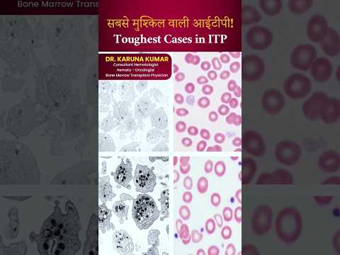 सबसे मुश्किल वाली आईटीपी! Toughest Cases in ITP#itp #refractoryItP #hematologist #drkarunakumar