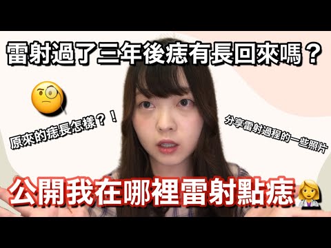 公開我在哪裡雷射點痣 雷射點痣三年後痣長回來了嗎？！🧐分享一些未點痣前的照片 | Kayo Channel