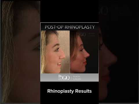 Before and after Rhinoplasty - Dr Guncel Ozturk