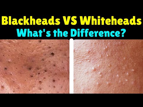 Blackheads VS Whiteheads VS Pimples: What's the Difference?