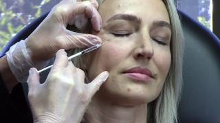 Botox Around the Eyes ~ Prevent Crows Feet