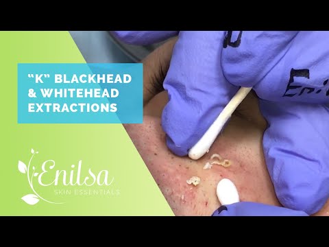 Blackheads, Whiteheads Extractions on "K" - Part 2