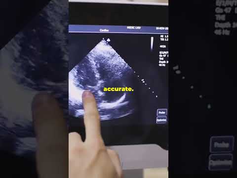 Revolutionizing Ultrasound: GE Verisound AI!