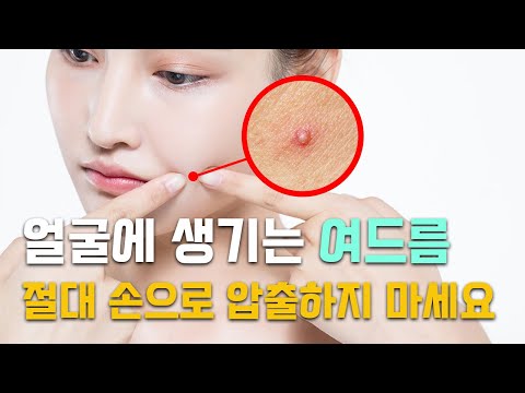 여드름에는 어떤 레이저 치료가 진행되나요?│여드름파인흉터