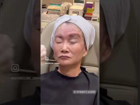 70대 쳐진눈 리프팅! 숨은 쌍커플 찾기 #beauty