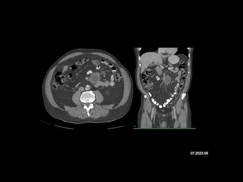 Radiology Case of the Week: The most likely diagnosis in this case is?