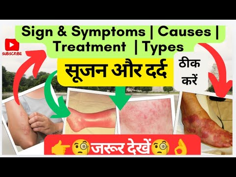 सूजन और दर्द का इलाज🧐 | inflammation and pain | Inflammation in Hindi | sign symptoms | medicines🧐