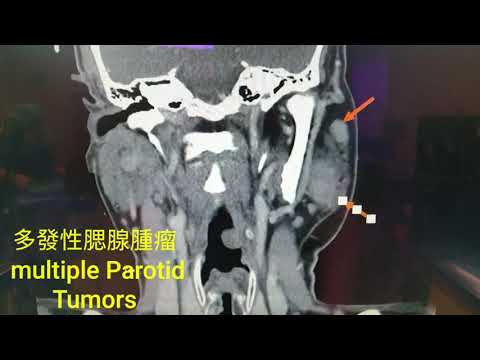 腮腺腫瘤 parotid tumor