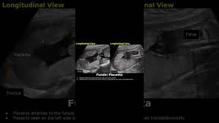 Posterior & Fundal Placental Position On Ultrasound | Pregnancy USG #posteriorplacenta #placenta