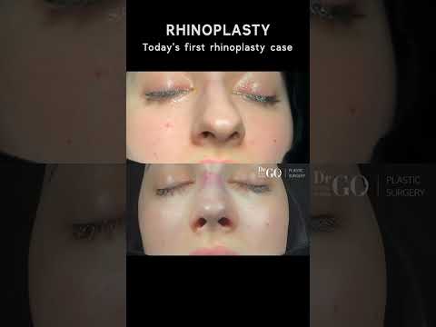 Patient Journey: Rhinoplasty Transformation 🌟