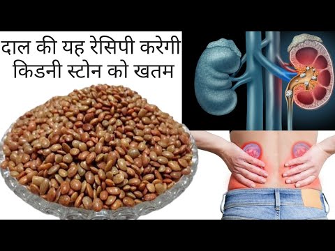 यह दाल खाकर किडनी स्टोन होगा ठीक | Remedy | Kidney Stone Food to eat | Kulth ki Dal | Kulthi Dal