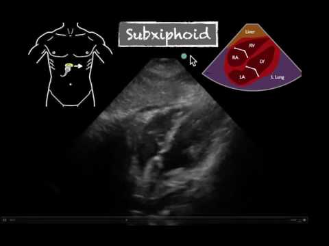 POCUS Cardiac Subxiphoid Normal EF