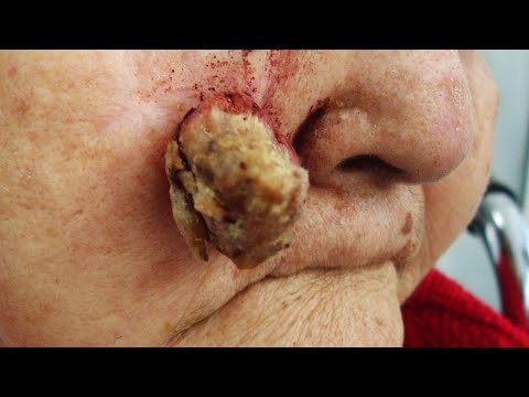 new blackheads this week 2021  | Pimple Popper