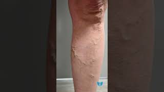 What to Expect During and After a VenaSeal™ Procedure for Varicose Vein Treatment